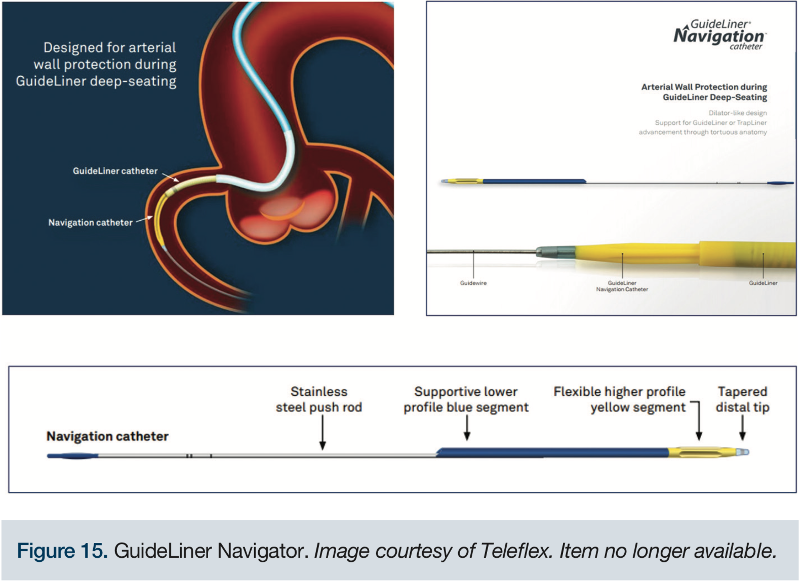 Guide Catheter Extension for Complex Percutaneous Coronary